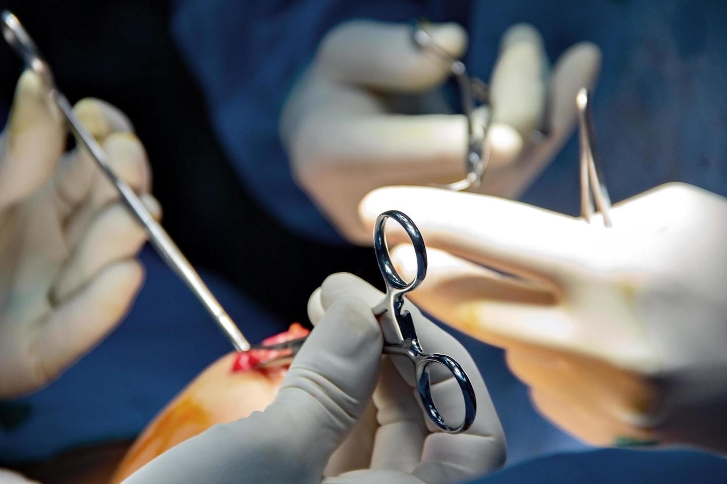 Bauchdeckenstraffung und Fettabsaugung: Plastische Chirurgie Bochum informiert